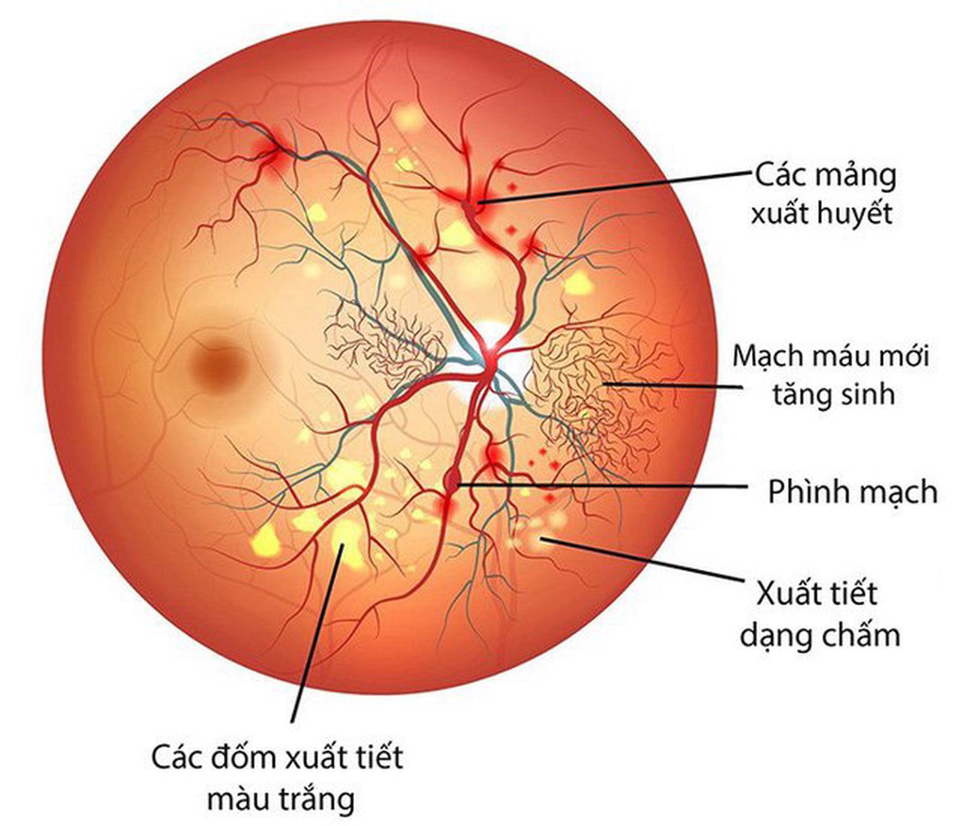 phat-hien-va-dieu-tri-som-benh-ly-day-mat-de-tranh-nguy-co-mu-loa