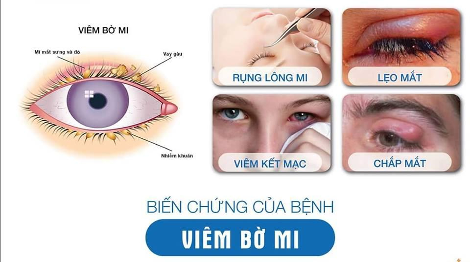 Biến chứng của viêm bờ mi