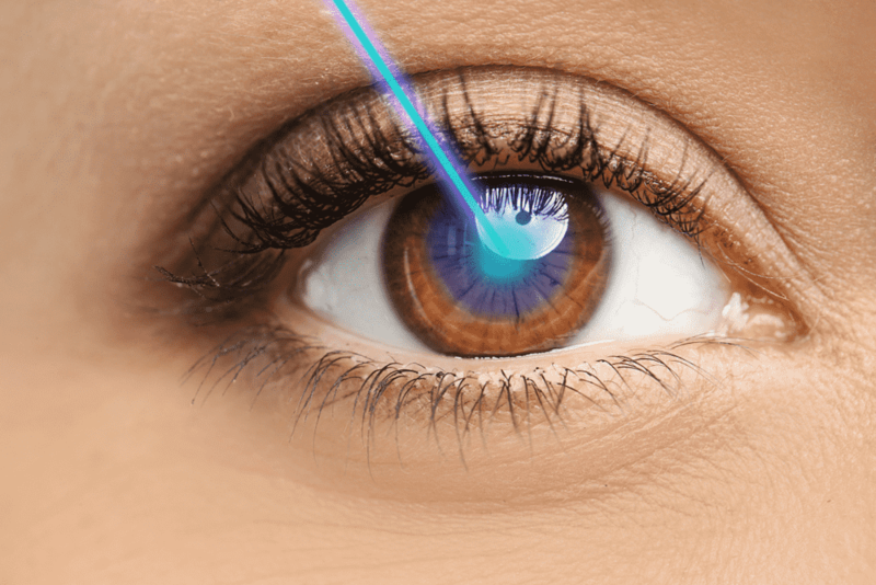 Phẫu thuật Lasik 7