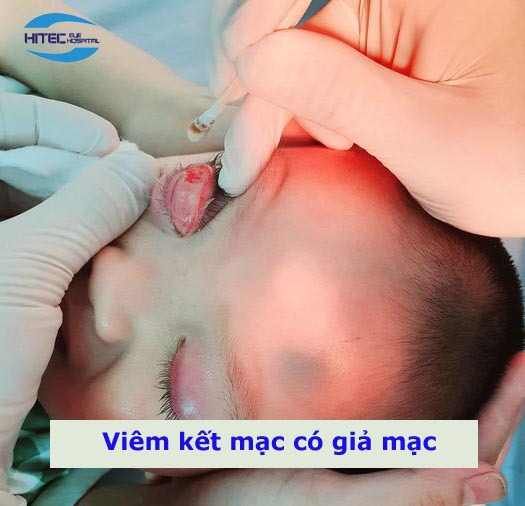 chan-doan-va-dieu-tri-benh-viem-ket-mac-co-gia-mac