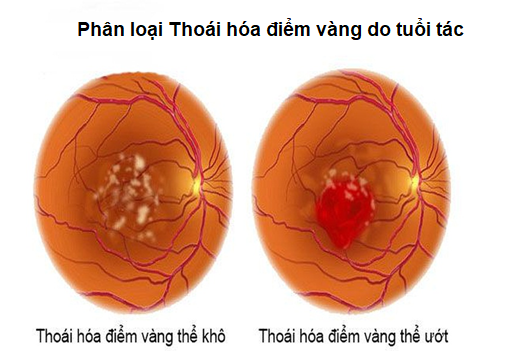 Phân loại thoái hóa hoàng điểm thể khô và thể ướt